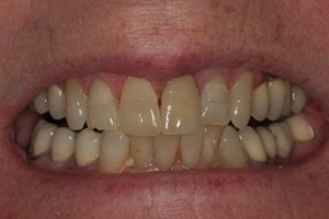 tender dental care clacton after crown
