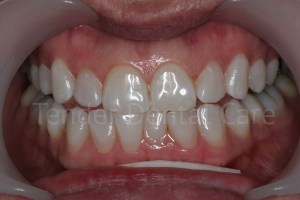 tender_dental care clacton essex after whitening