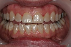 tender_dental care clacton essex before whitening
