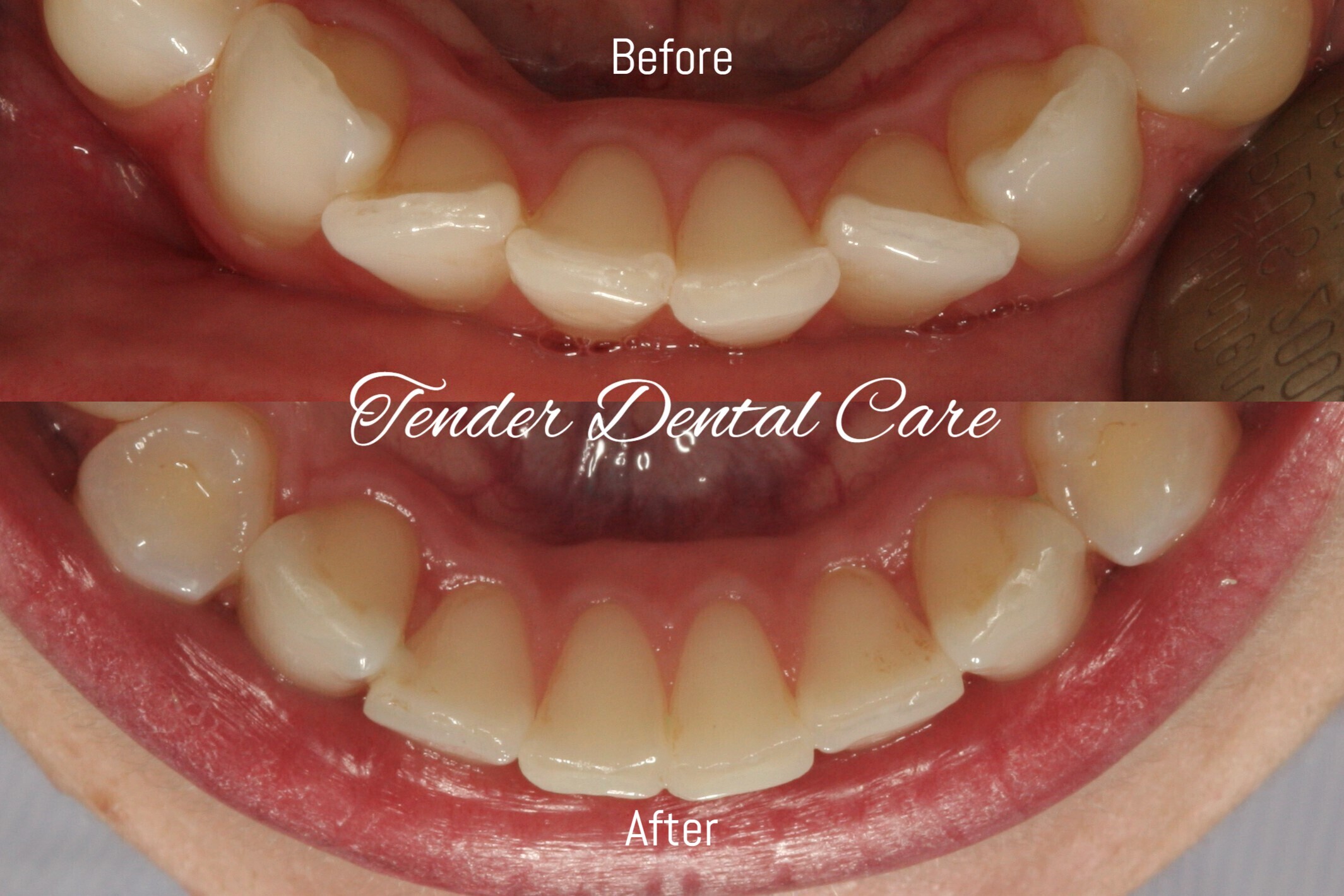 Clear smile aligner