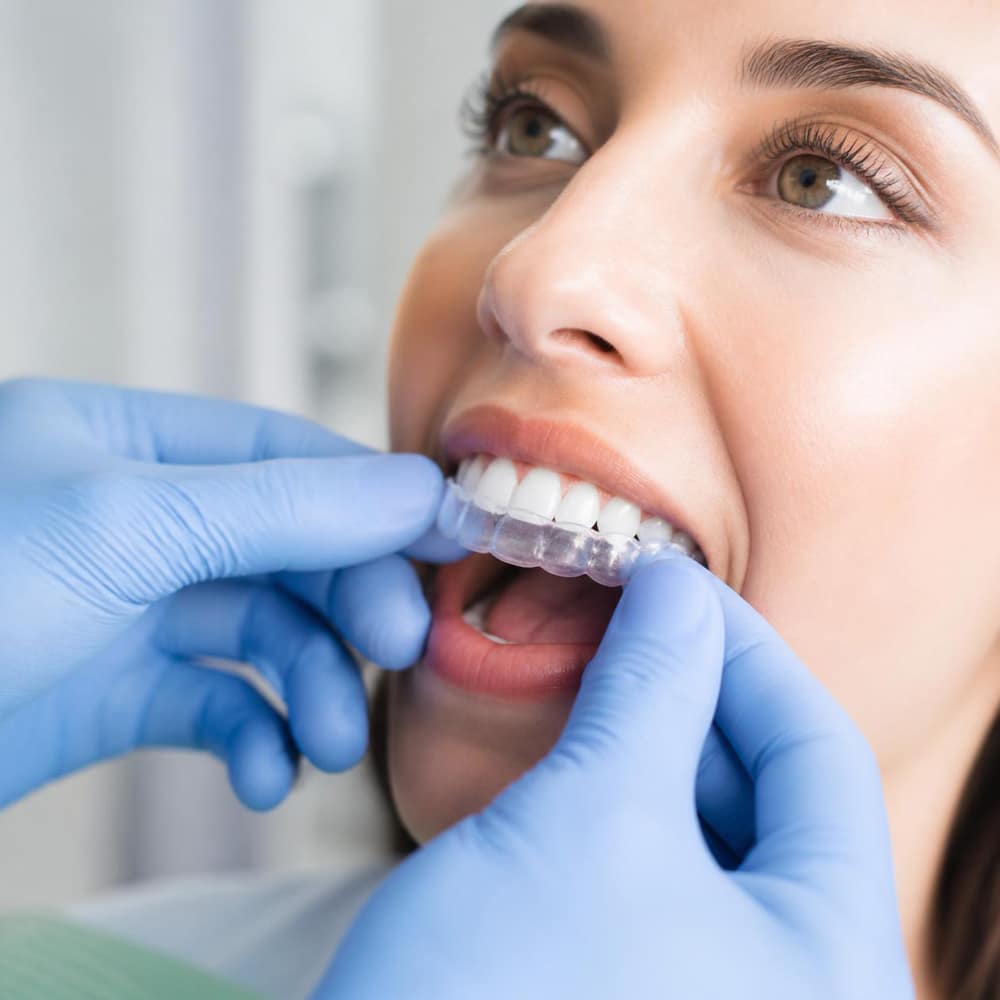 bite guards in clacton-on-sea tender dental care