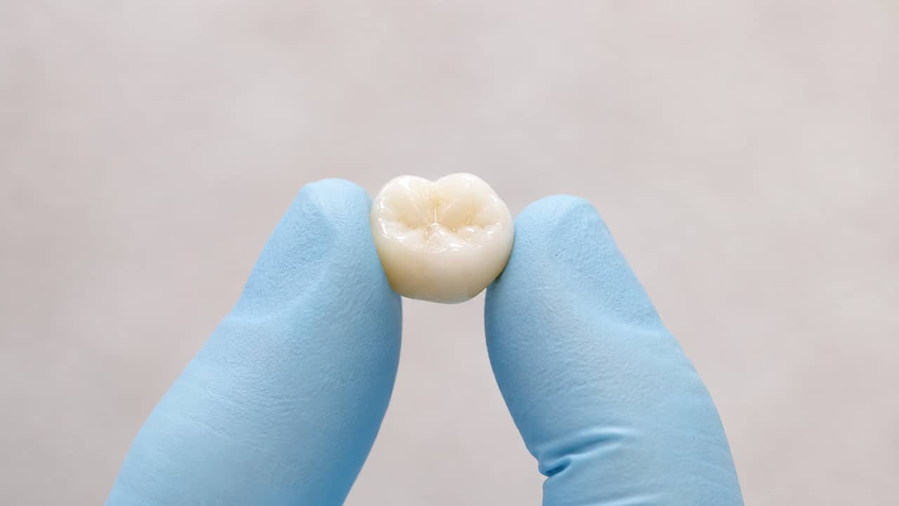 Can You Have an Onlay Instead of a Crown?