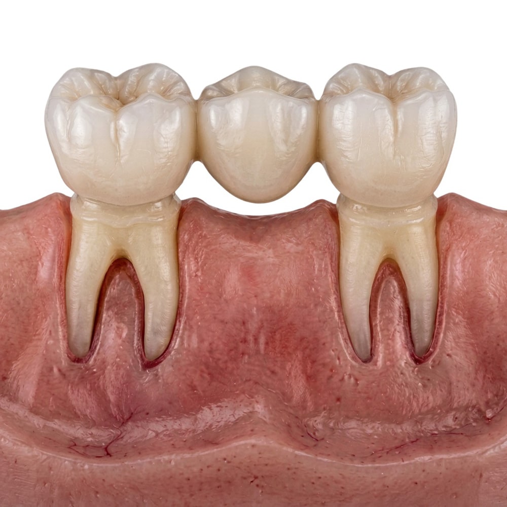 dental bridges in clacton-on-sea