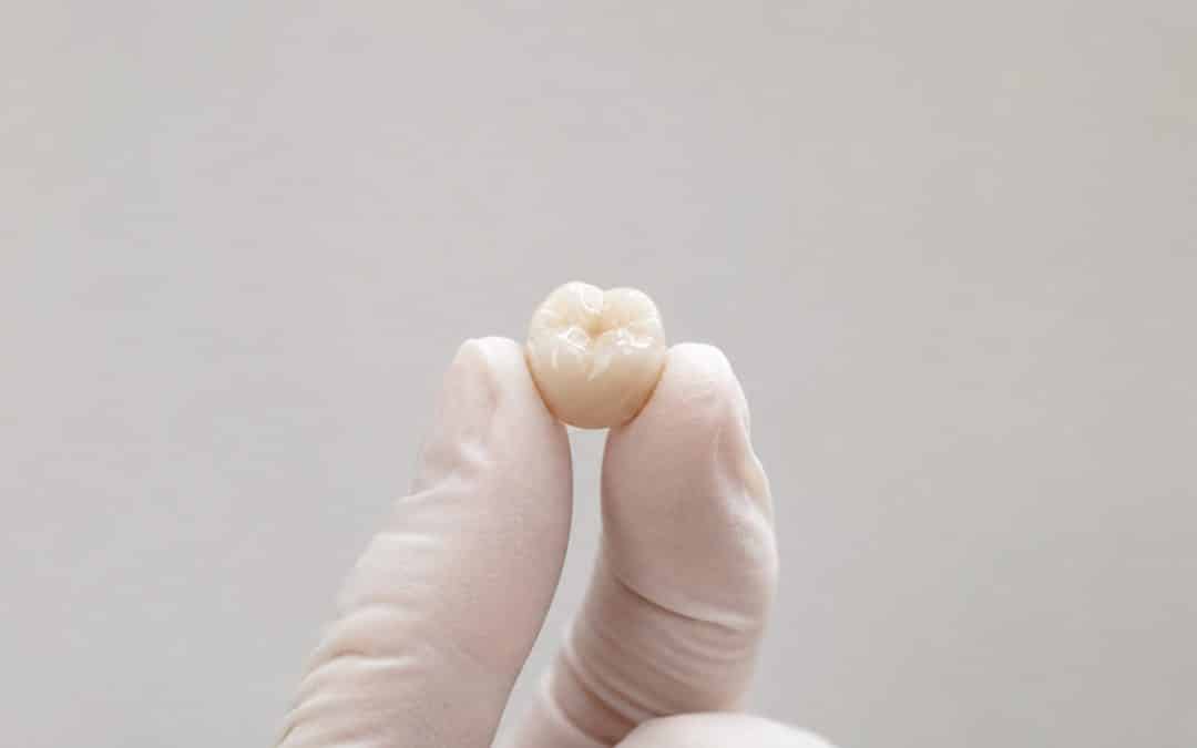 How Long Does a Dental Crown Last?
