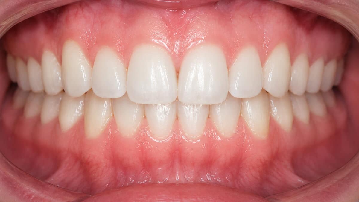 Straightened front teeth after anterior aesthetic orthodontics with the Inman Aligner in Clacton-on-Sea