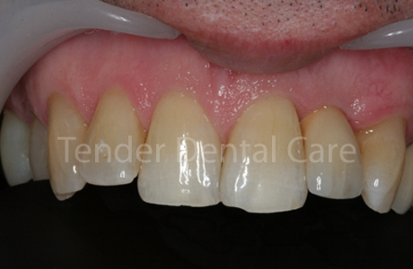 after implant