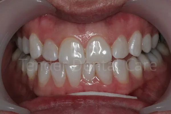 after whitening