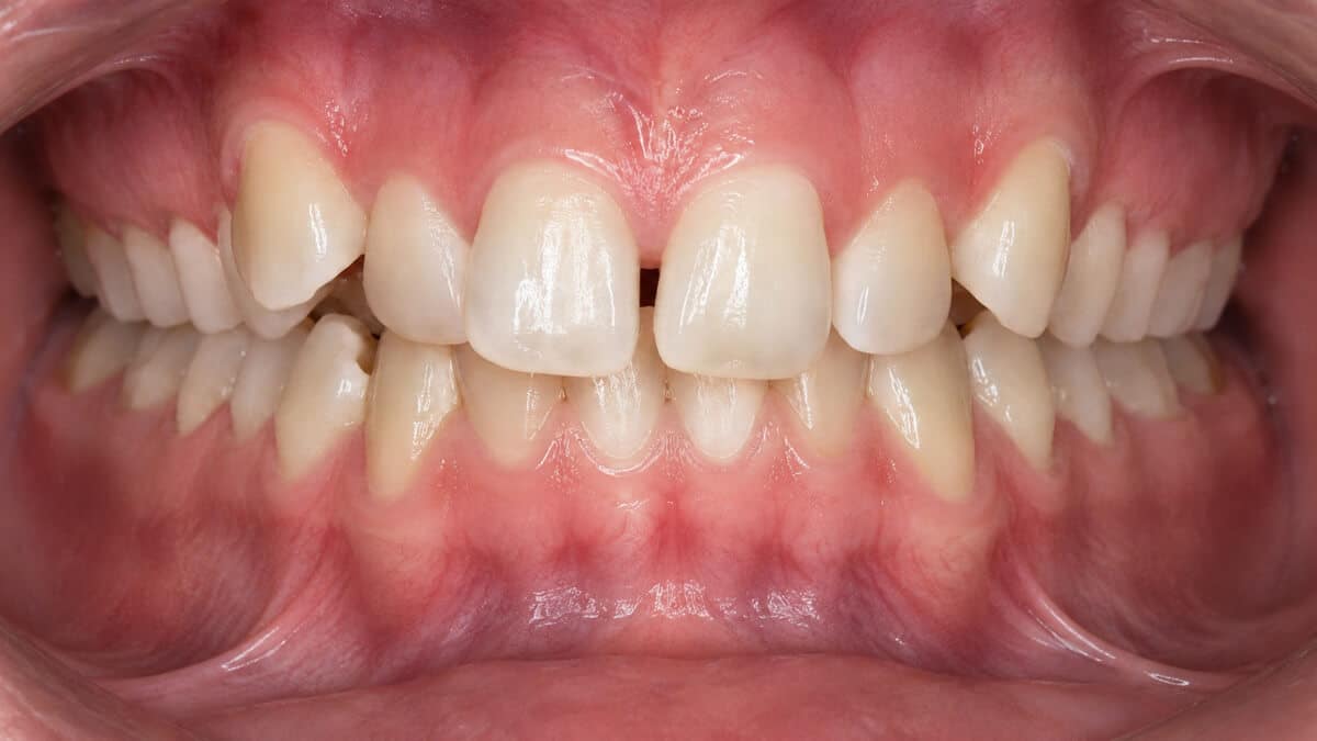 Crowded front teeth before anterior aesthetic orthodontics at Tender Dental Care Clacton-on-Sea