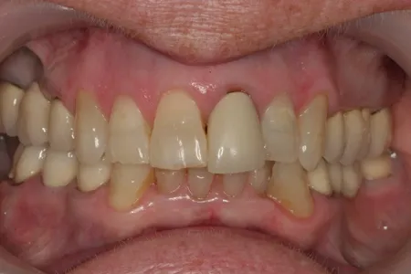 before crown