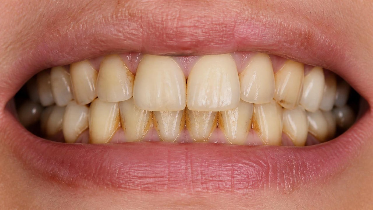 tender dental care clacton essex before dental hygiene