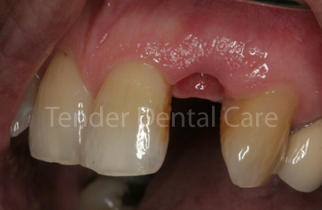 before implant