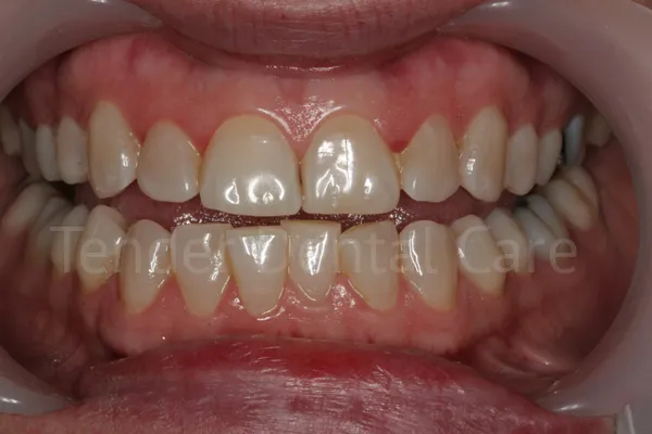 before whitening