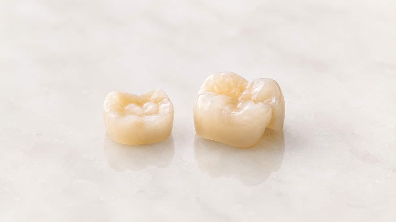 The Difference Between an Inlay and an Onlay