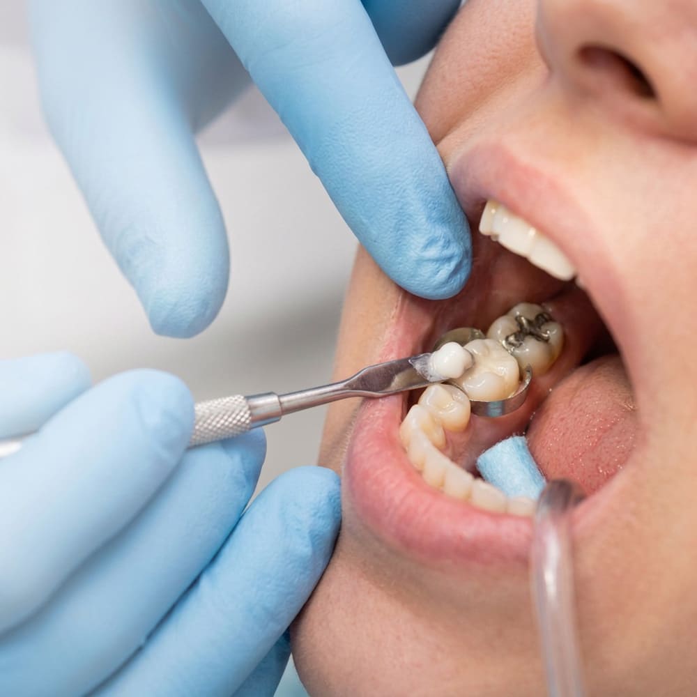 white fillings in Clacton-on-Sea